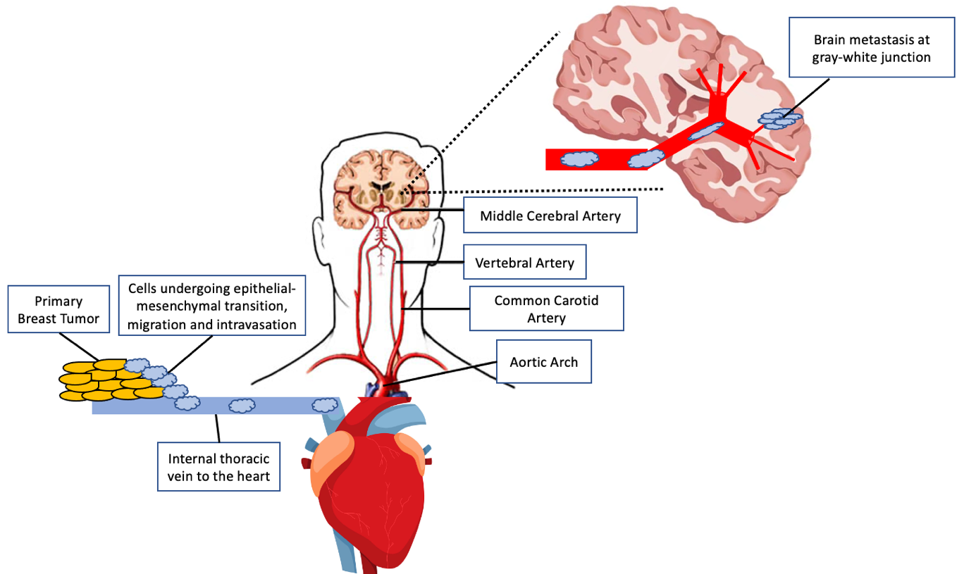 Vascular routes from a breast cancer primary tumor to a cerebral metastasis