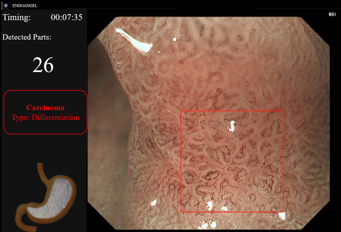 The lesions were observed under narrow-band imaging (ME-NBI). There was a clear demarcation line (DL)  around the lesion with irregular glands, and microvessels varied in diameter and size and were irregular in shape. And  ENDOANGEL diagnosed the lesion as differentiated carcinoma.